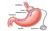 Gastric Band Surgery (Lap-band) in Monterrey, Mexico