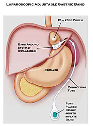 Gastric Bypass in Monterrey, Mexico • Check Prices & Reviews