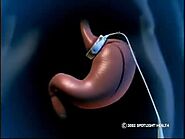 What is the cost of Gastric Bypass in Chihuahua, Mexico?