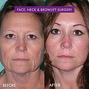 A Full Facelift Can Help You Look Rested and Rejuvenated from the Hairline to Neck