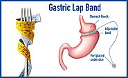 Going for Popular Lap Band Surgery in Cancun, Mexico