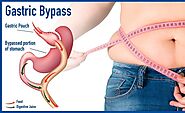 Bariatric Surgery Medical Tourism Travel to Cancun