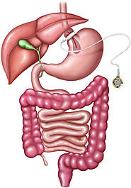 Sonora Bariatrics in Hermosillo, Mexico