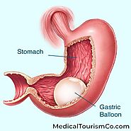 Bariatric Surgery in Mexicali, Mexico | Safe, Affordable WLS in Mexico