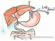 Gastric Banding in Mexicali | Lap Band Surgery in Mexicali Mexico
