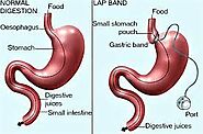 Gastric Sleeve in Mexicali, Mexico • Check Prices & Reviews