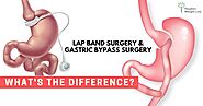 Gastric Band (LAP-BAND) Surgery in Tijuana, Mexico - Dr. Lopez Corvala