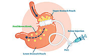 Gastric Sleeve Surgery In Mexico City | Medical Tourism Mexico