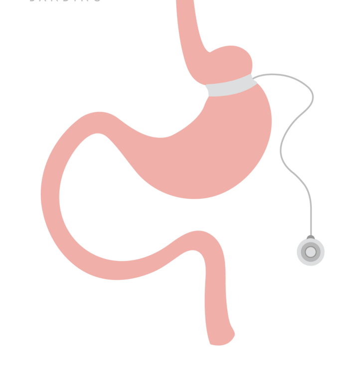 Lap Band Surgery in Chimalhuacán A Listly List