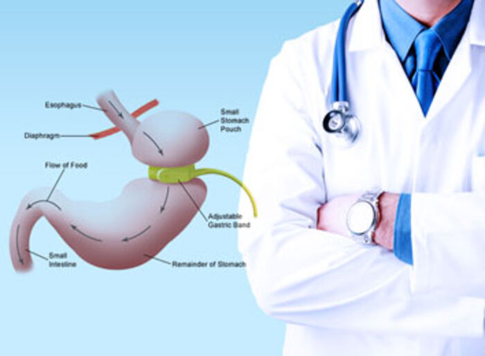 Lap Band Surgery in Chimalhuacán A Listly List