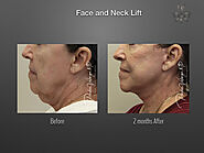 Face lift surgery in Soledad | A Listly List