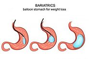 Dr. Fernando Garcia, WLS - Bariatric Mexico Surgery