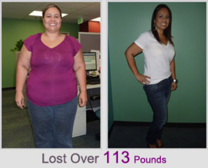 Lap Band Surgery in Durango A Listly List