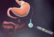 What Is LAP-BAND Surgery | LAP-BAND Procedure | BMCC