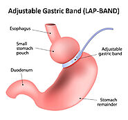 Lap Band in Mexico (Gastric Banding): Starting at $5,495