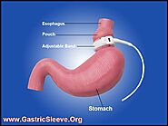 Low priced Gastric Band at Surgimed Clinica Ensenada Mexico