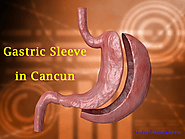 Sleeve Gastrectomy in Cancun | Gastric Sleeve Cost | Medical Tourism Co