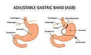 LAP-Band Surgery in Los Angeles, CA - Doctor Bariatric