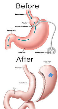 Dr Kuri & Associates | The #1 Choice for Gastric Sleeve Surgery in Mexico