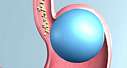 Lap Band Surgery | UM Upper Chesapeake Health