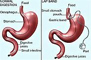 Bariatric Surgery: Palmetto General