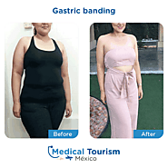 Gastric banding - weight loss procedure information and locations in Mexico