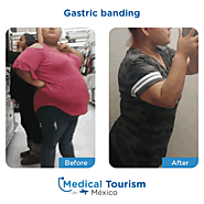 Gastric banding - weight loss procedure information and locations in Mexico