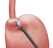 Laparoscopic Lap Band Placement - StatPearls - NCBI Bookshelf