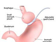 Gastric bands: How it works, surgery, who should have it