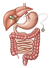 Lap Band Surgery – DHR