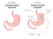 LAP-BAND Surgery, Laparoscopic Adjustable Gastric Banding - Suwanee, Johns Creek, Alpharetta | Atlanta Bariatrics