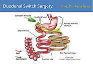 Duodenal Switch Tijuana, Mexico - Biliopancreatic Diversion - ALO Bariatrics