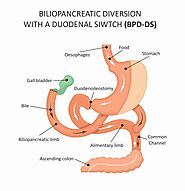 DuoDenal Switch | Dr. Jaime Ponce De Leon | Mexico Bariatric Surgeon