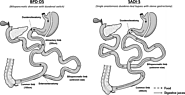 Duodenal Switch Mexico: Bariatric Mexico