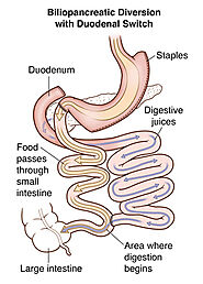 Duodenal Switch (BPD-DS) | Columbia University Department of Surgery