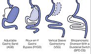 Duodenal Switch Surgery - Beltline Bariatric & Surgical Group Atlanta and Newnan GA