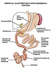 duodenal-switch - International Patient Facilitators