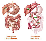 Duodenal Switch Surgery | Lenox Hill Bariatric Surgery Program, Manhattan NY