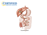 Open Duodenal Switch Surgery Tijuana, Mexico - Monterrey, Mexico - Tijuana Bariatrics, LLC