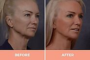 Facelift Surgery Sydney By Renowned Facial Surgeon Dr. Hodgkinson