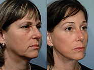 Face Lift Surgery | The Plastic Surgery Clinic & Medispa Sydney