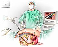 Sydney Gastric Sleeve Surgery - Laparoscopic Sleeve Gastrectomy