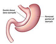 Gastric Band Surgery Melbourne | Orbera Balloon Surgery Melbourne - Greater Eastern Obesity Surgery