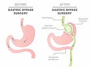 Gastric Bypass Melbourne, Vic - Weight Loss Surgeon