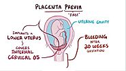 What is Placenta Previa? | Specialty Care Clinics