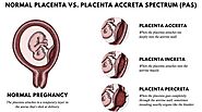 What is Placenta Accreta? | Specialty Care Clinics