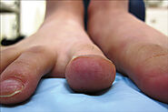 What are Chilblains? | Specialty Care Clinics
