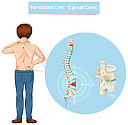 Top Treatments for Bulging Disc | Specialty Care Clinics