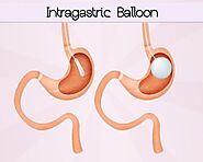 Gastric Balloon | New Body Specialist Bariatrics Australia