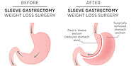Leading Weight Loss Surgeon in Melbourne. Gastric Sleeve, Gastric Band, and Gastric Balloon. Weekly lists at Knox Pri...